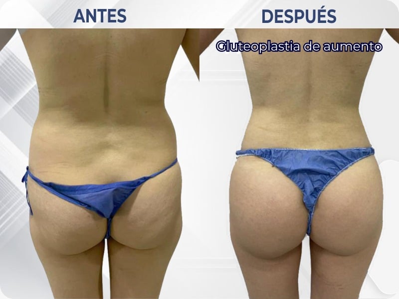 Gluteoplastia – Doctora del Río